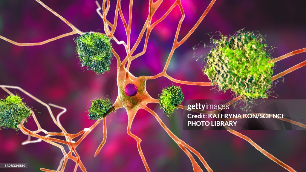 Nerve cells affected by Alzheimer's disease, illustration