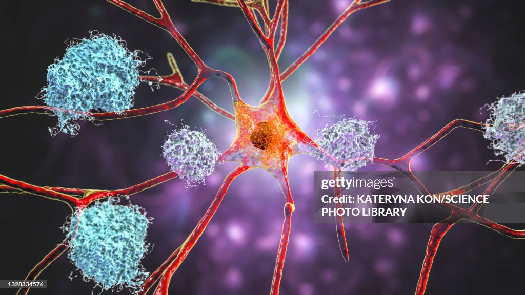 Nerve cells affected by Alzheimer's disease, illustration