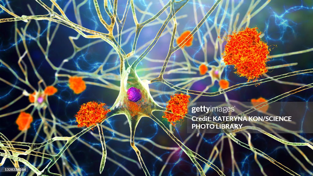 Nerve cells affected by Alzheimer's disease, illustration