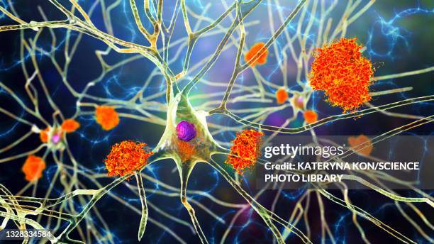 bildbanksillustrationer, clip art samt tecknat material och ikoner med nerve cells affected by alzheimer's disease, illustration - nervcell