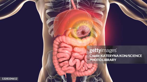 gastric ulcer, illustration - gastric acid stock illustrations