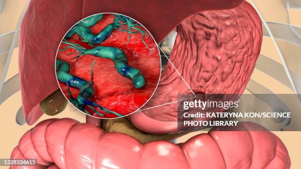 gastric ulcer, illustration - gastric acid stock illustrations