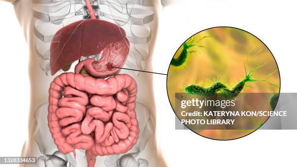 gastric ulcer and helicobacter pylori bacteria, illustration - helicobacter pylori stock-grafiken, -clipart, -cartoons und -symbole