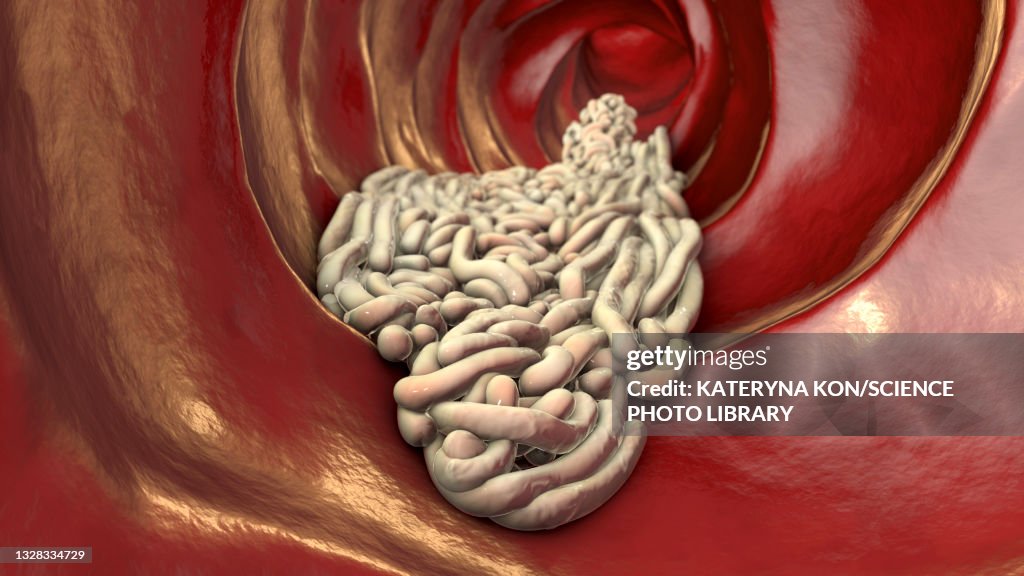 Round worms in human intestine, illustration