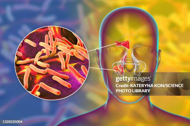 sinusitis, illustration - sinus stock-grafiken, -clipart, -cartoons und -symbole