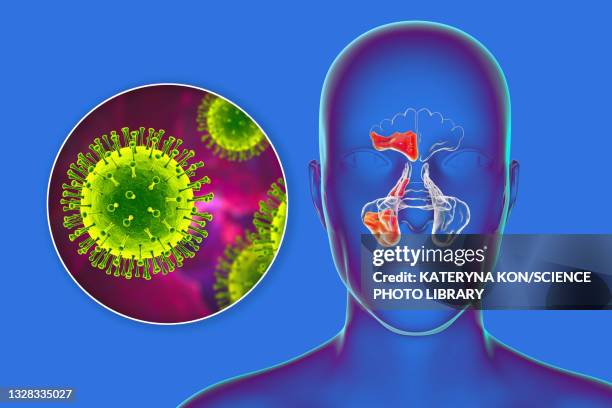 sinusitis, illustration - sinusitis stock-grafiken, -clipart, -cartoons und -symbole