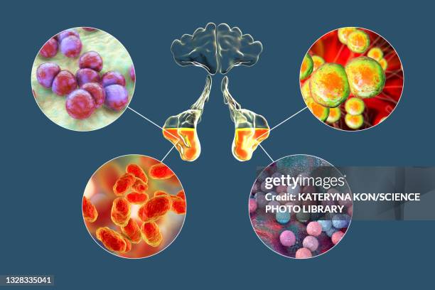 sinusitis, illustration - staphylococcus aureus stock illustrations