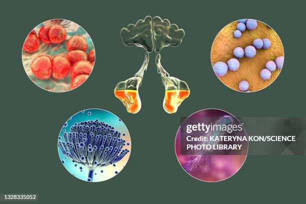 sinusitis, illustration - streptococcus pyogenes stock illustrations
