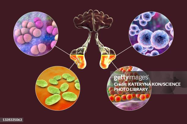 sinusitis, illustration - staphylococcus aureus stock illustrations