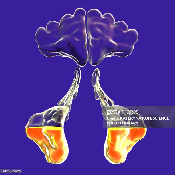 sinusitis, illustration - staphylococcus aureus stock illustrations