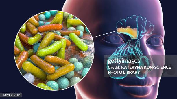 sinusitis, illustration - sinusitis stock-grafiken, -clipart, -cartoons und -symbole