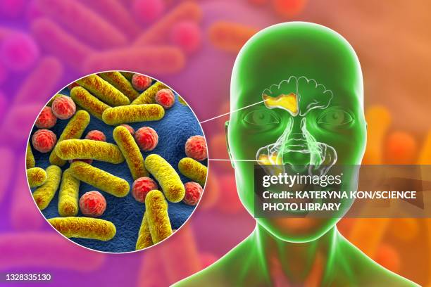 sinusitis, illustration - staphylococcus aureus stock illustrations