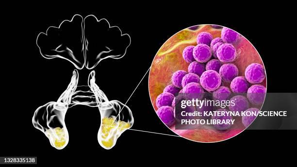 sinusitis, illustration - staphylococcus aureus stock illustrations