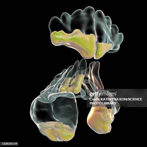 stockillustraties, clipart, cartoons en iconen met sinusitis, illustration - slijm