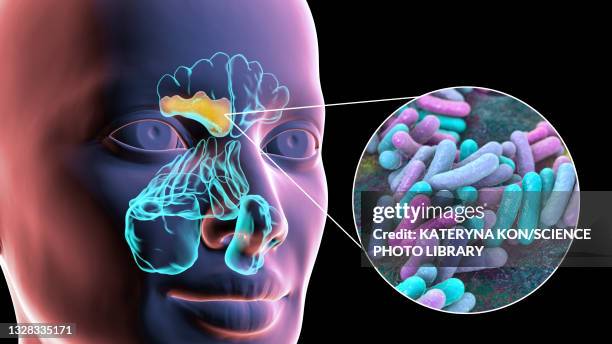 sinusitis, illustration - streptococcus pneumoniae stock illustrations