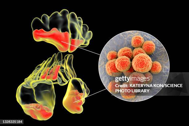 sinusitis, illustration - staphylococcus aureus stock illustrations