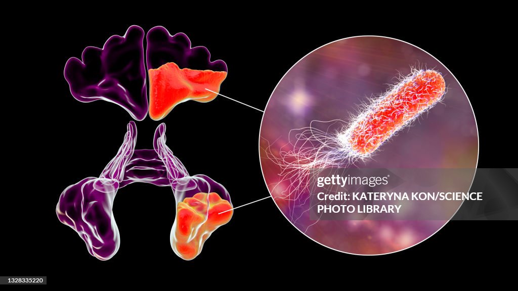 Sinusitis, illustration