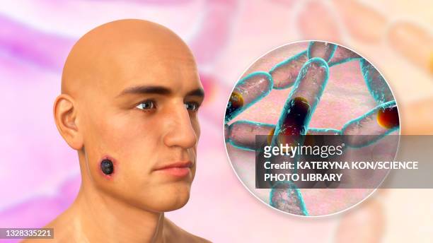 stockillustraties, clipart, cartoons en iconen met cutaneous anthrax, illustration - bacillus subtilis