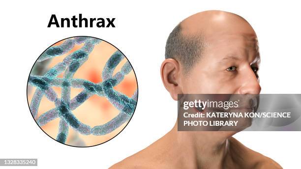 cutaneous anthrax, illustration - sepsis stock illustrations
