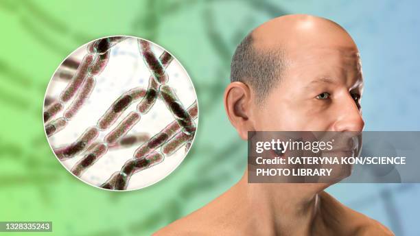 cutaneous anthrax, illustration - man surrounded stock illustrations