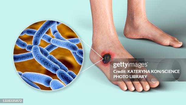 cutaneous anthrax, illustration - man surrounded stock illustrations