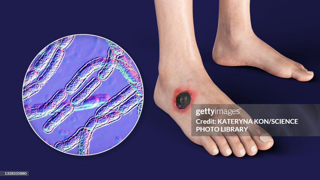 Cutaneous anthrax, illustration