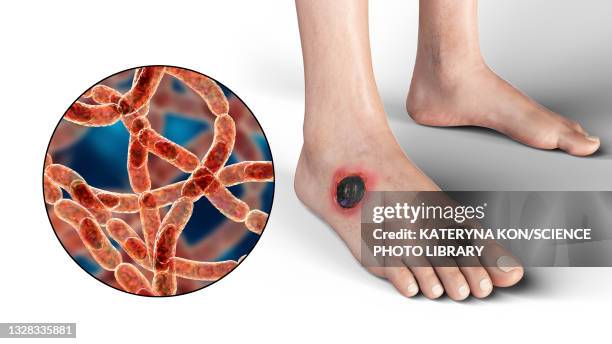 Internal Anthrax 84 Cutaneous Anthrax Stock Photos, High-Res Pictures, and Images ...