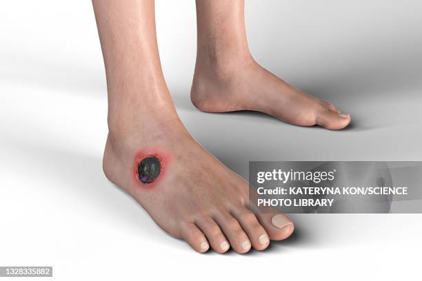cutaneous anthrax, illustration - man surrounded stock illustrations