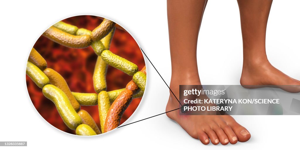 Anthrax Color Cutaneous Anthrax Illustration High-Res Vector Graphic - Getty Images