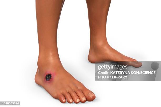 cutaneous anthrax, illustration - cutaneous anthrax stock illustrations