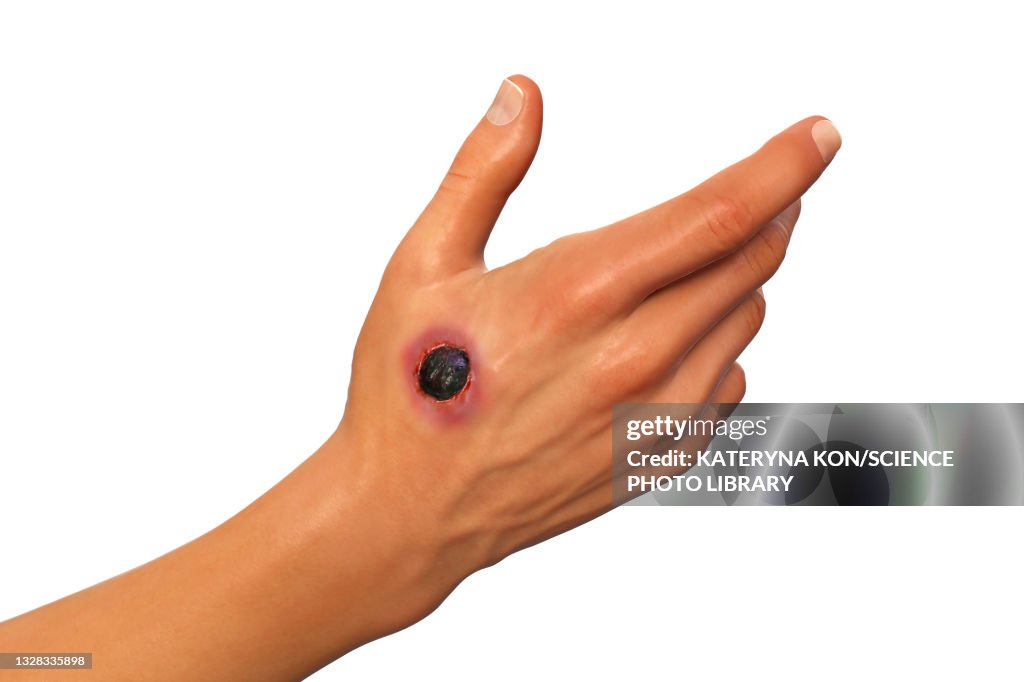 Anthrax Color Cutaneous Anthrax Illustration High-Res Vector Graphic - Getty Images