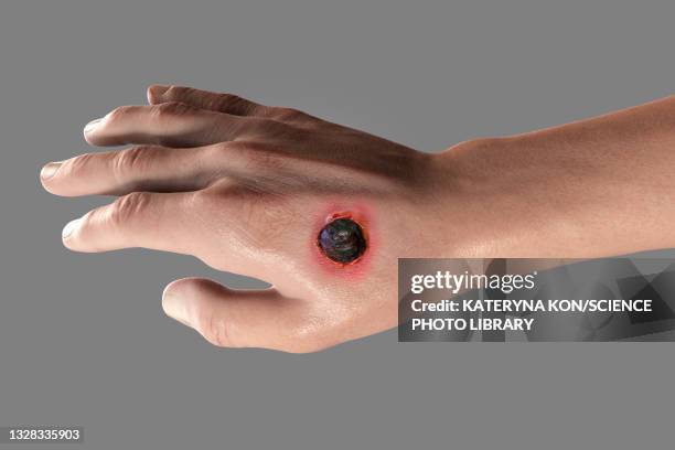 cutaneous anthrax, illustration - sepsis stock illustrations