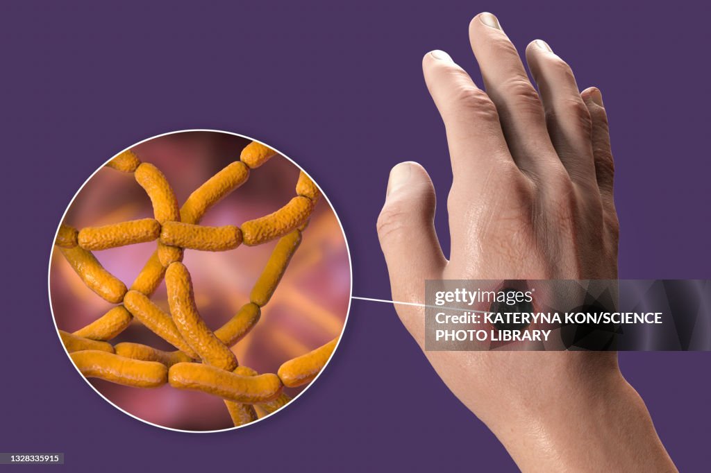 Cutaneous anthrax, illustration