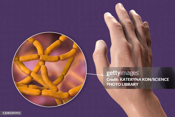 cutaneous anthrax, illustration - bacillus-subtilis stock illustrations