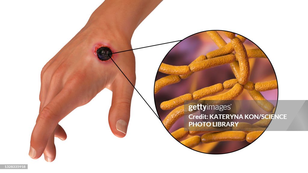 Anthrax Color Cutaneous Anthrax Illustration High-Res Vector Graphic - Getty Images