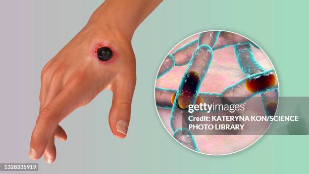 cutaneous anthrax, illustration - cutaneous anthrax stock illustrations