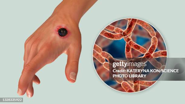 cutaneous anthrax, illustration - man surrounded stock illustrations