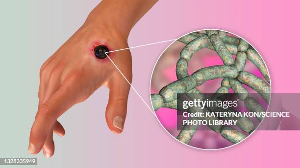 Internal Anthrax 84 Cutaneous Anthrax Stock Photos, High-Res Pictures, and Images ...