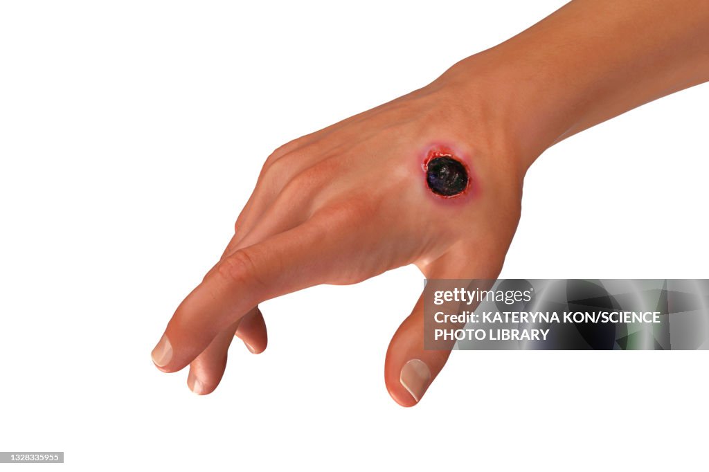 Anthrax Color Cutaneous Anthrax Illustration High-Res Vector Graphic - Getty Images