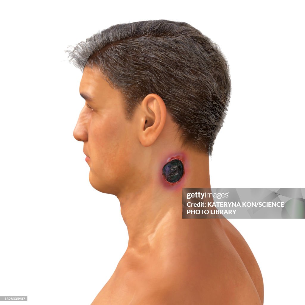 Anthrax Color Cutaneous Anthrax Illustration High-Res Vector Graphic - Getty Images