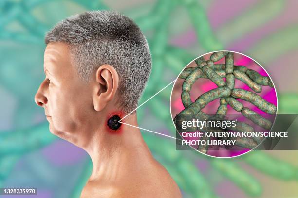 cutaneous anthrax, illustration - cutaneous anthrax stock illustrations