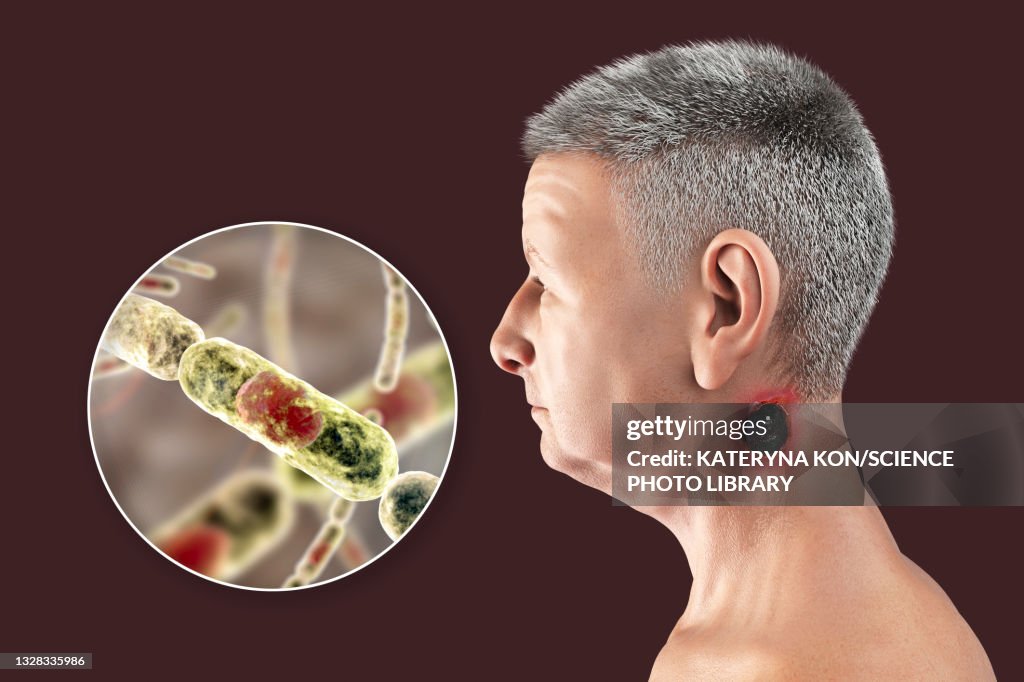 Anthrax Color Cutaneous Anthrax Illustration High-Res Vector Graphic - Getty Images