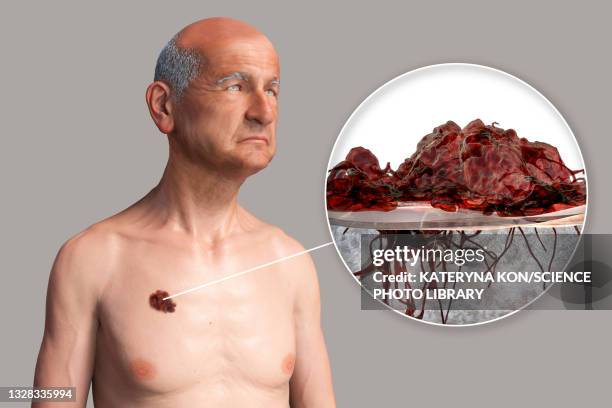 melanoma, illustration - melanoma stock illustrations
