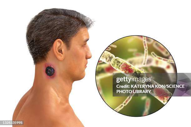 cutaneous anthrax, illustration - cutaneous anthrax stock illustrations