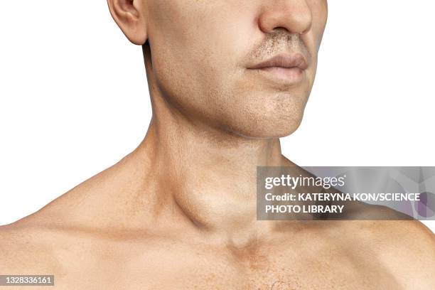 thyroid gland tumour, illustration - thyroid stock illustrations