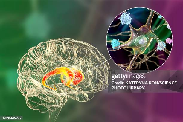 stockillustraties, clipart, cartoons en iconen met neuronal inclusions in huntington's disease, illustration - coronaal doorsnede