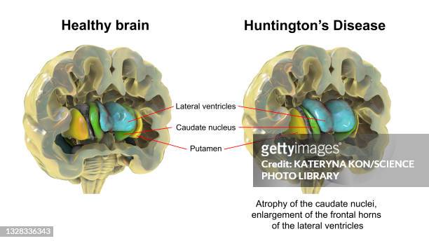 normal brain and brain in huntington's disease, illustration - neuropathy stock-grafiken, -clipart, -cartoons und -symbole