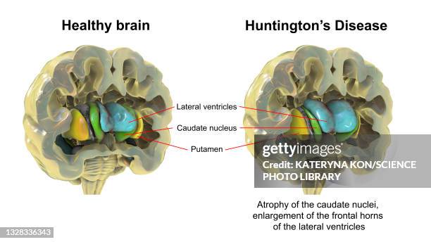 normal brain and brain in huntington's disease, illustration - coronal section stock illustrations