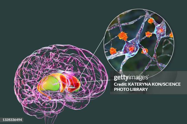 dorsal striatum in huntington's disease, illustration - coronal section stock illustrations