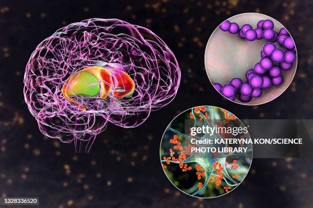 bildbanksillustrationer, clip art samt tecknat material och ikoner med sydenham's chorea, illustration - basal ganglia